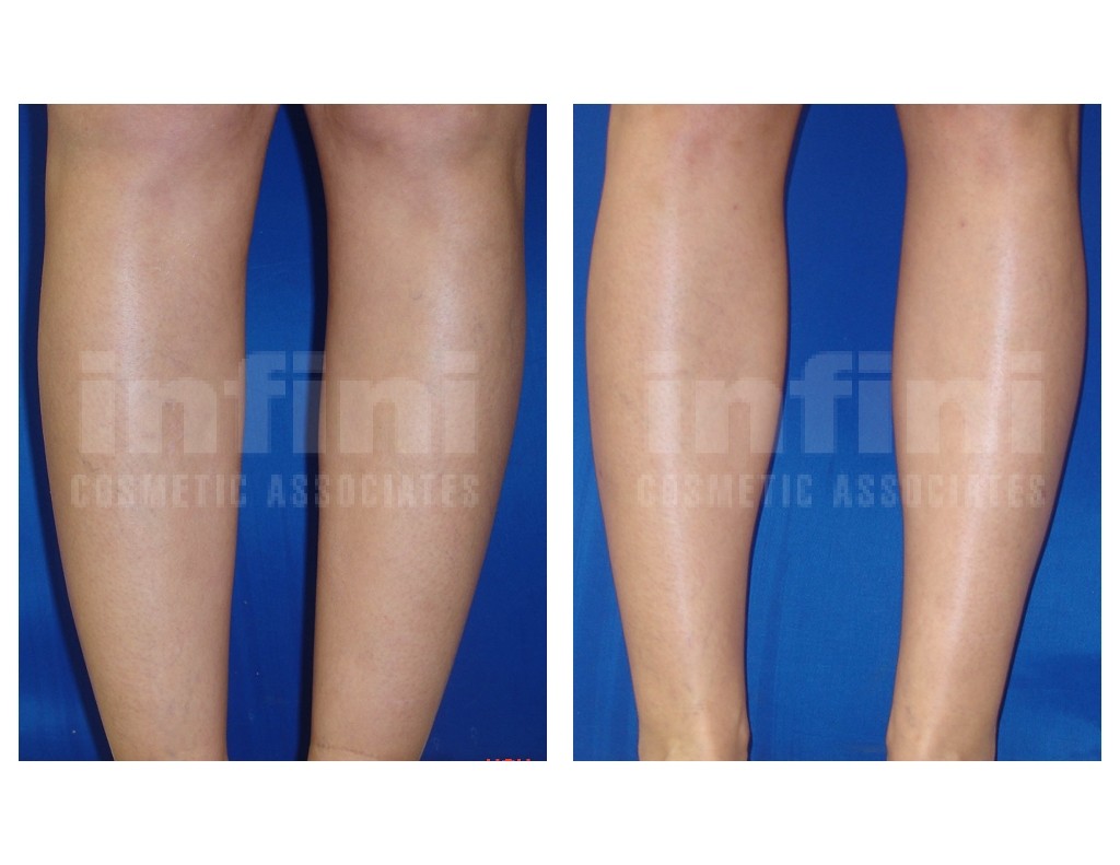 Calf and Ankle Liposuction Before and After Infini Phoenix Liposuction