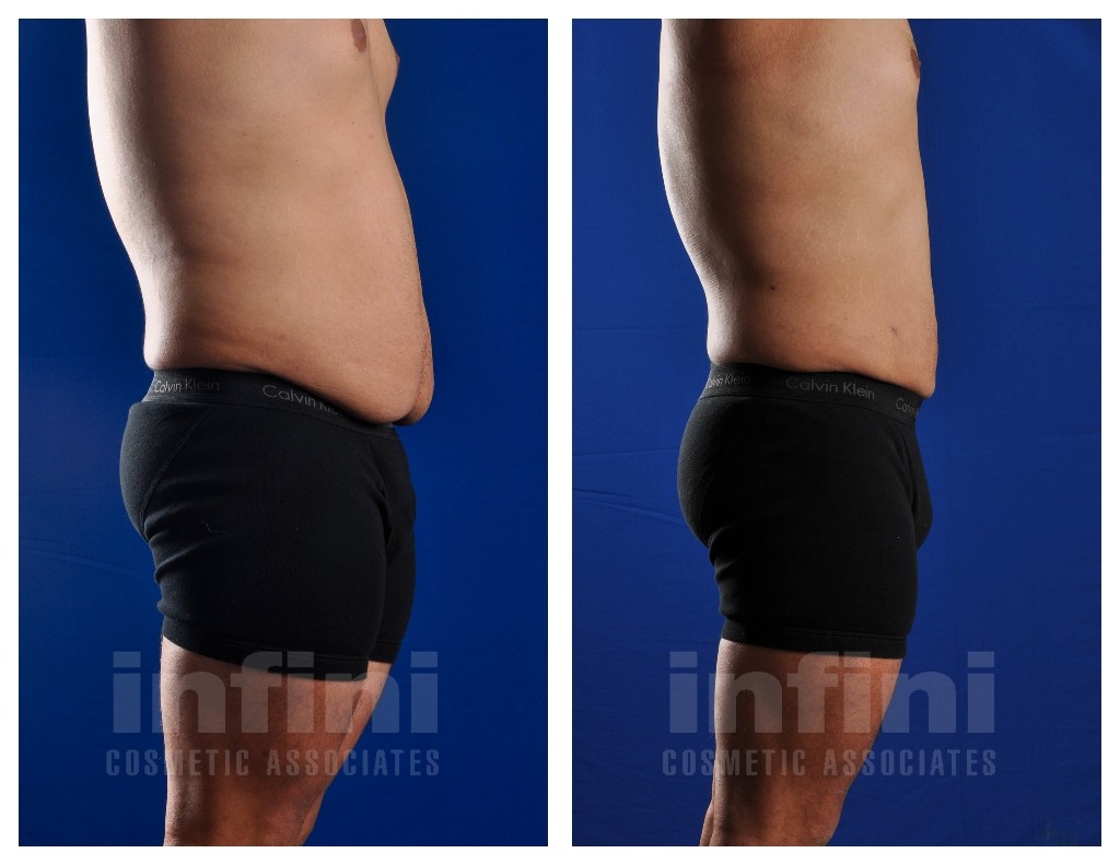 Male Liposuction Before & After Photos: Stomach | Phoenix Liposuction