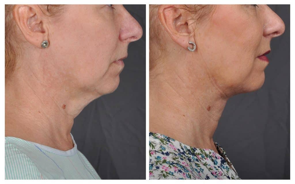 j-plasma before and after