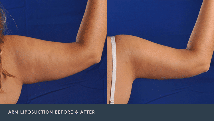 Arms Liposuction Before and After