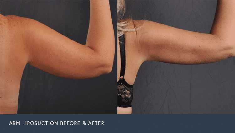 Arms Liposuction Before and After