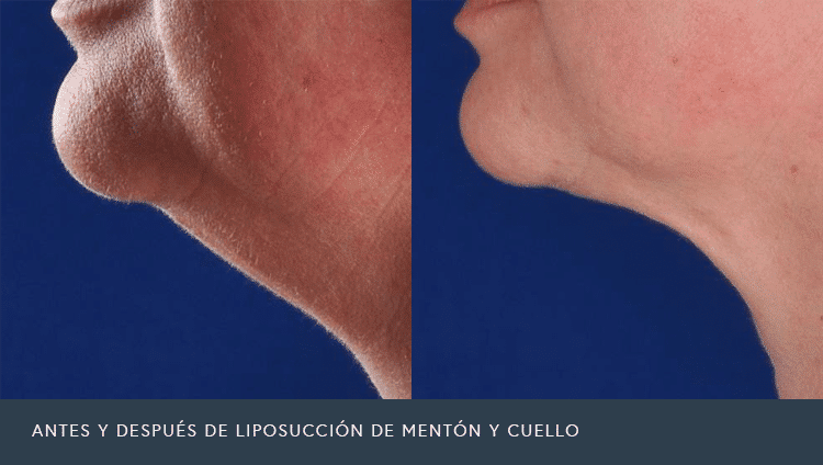 Liposucción de Mentón y Cuello Antes y Después