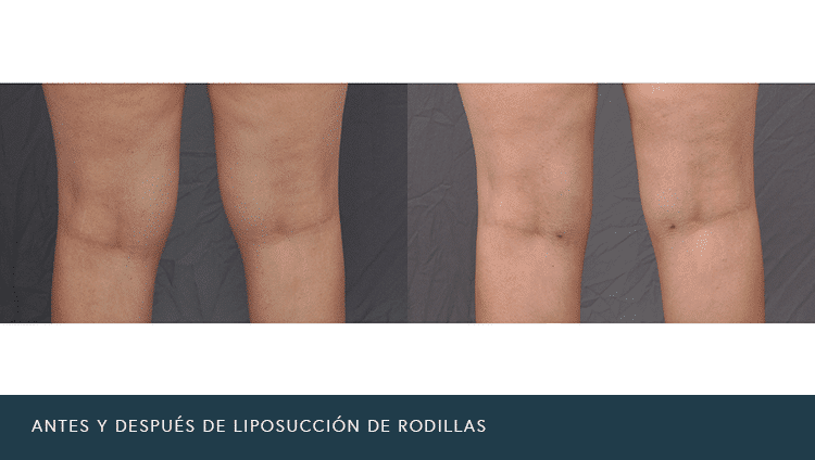 Antes y Después de Liposucción de Rodillas