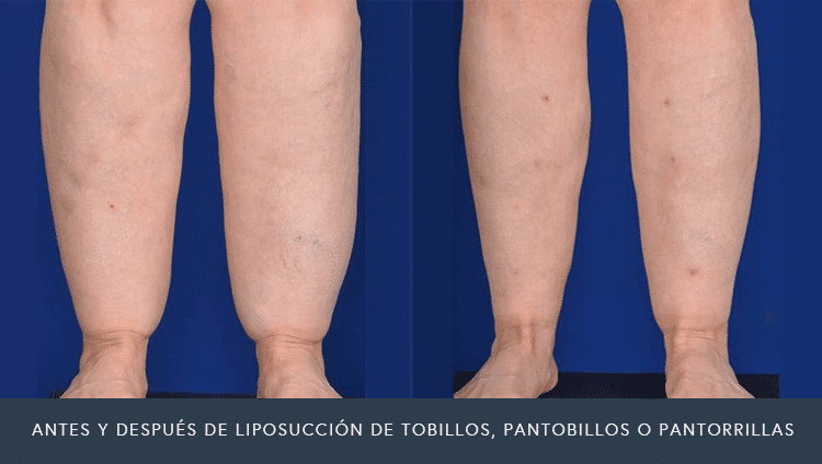 Antes y Después de Liposucción de Tobillos y Pantorrillas