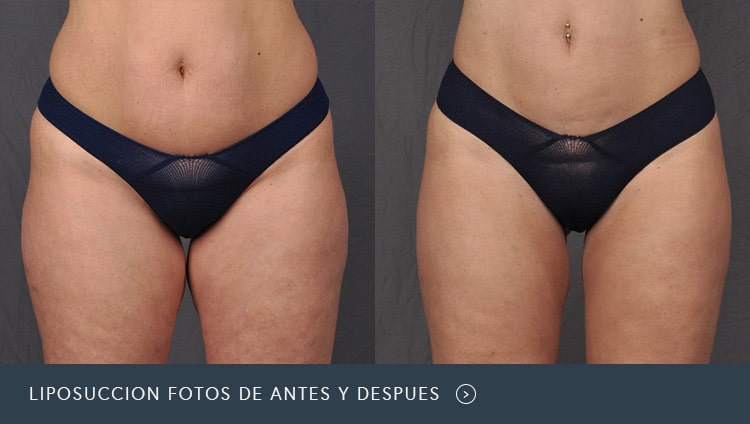 Liposucción Fotos de Antes y Después