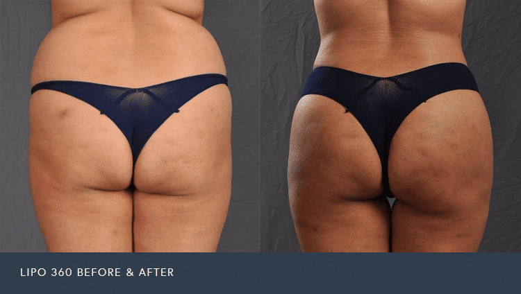 Liposuction of the Love Handles, Back and Buttocks - Lipo 360 Female Patient