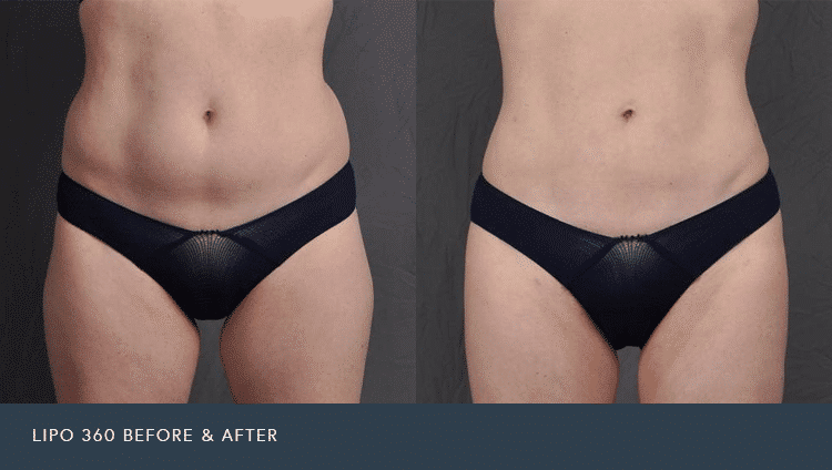 Liposuction of the Abdomen and Flanks - Lipo 360 Female Patient