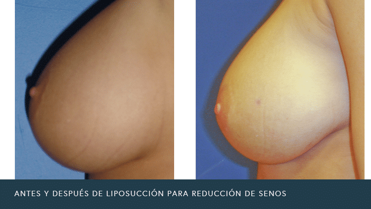 Antes Y después De liposucción para la reducción de senos