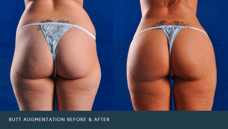 Butt Augmentation Before and After