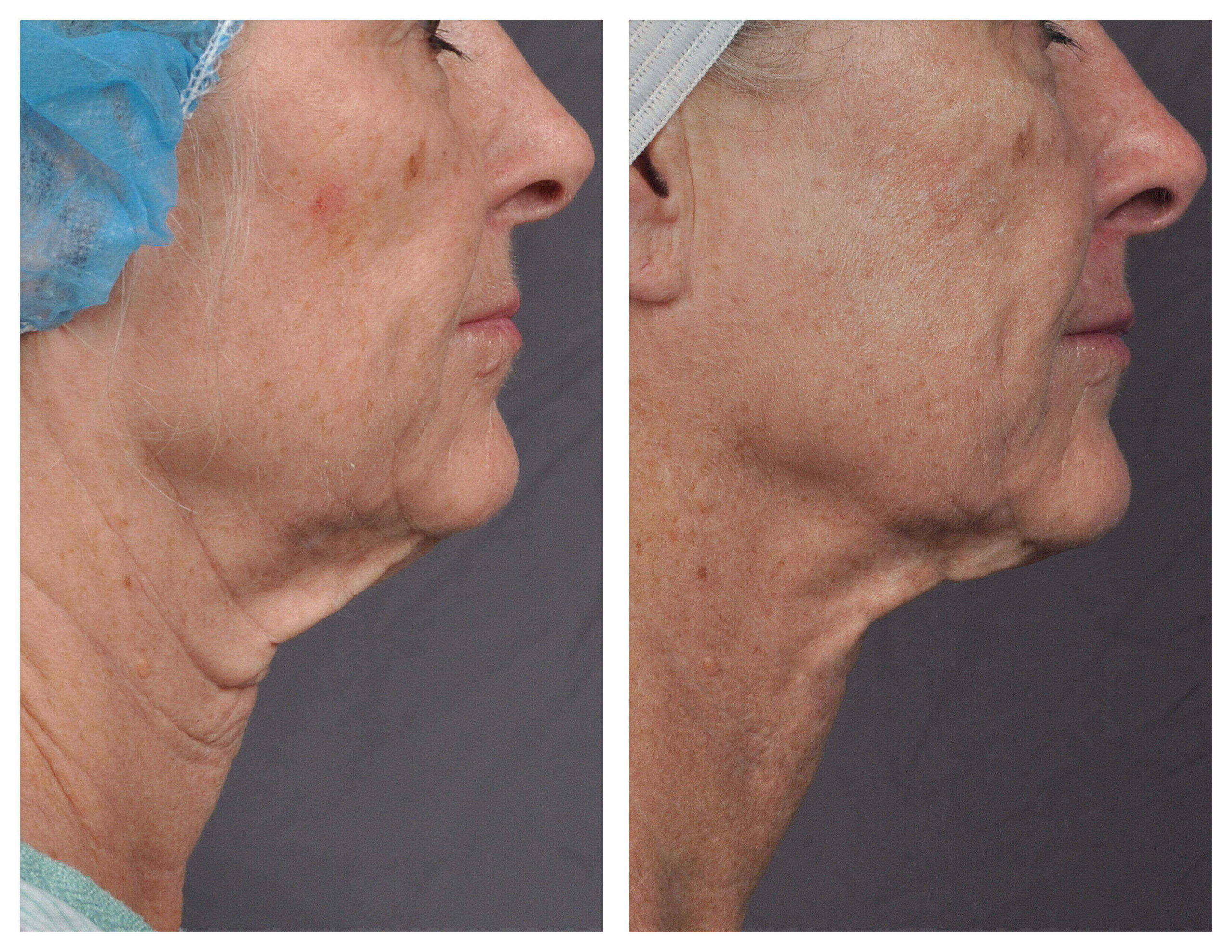j-plasma before and after