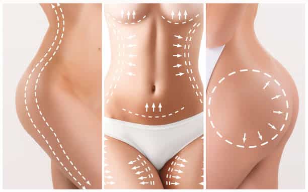 The cellulite removal plan. White markings on young woman body preparing for plastic surgery. Concept of slimming, liposuction, strand lifting