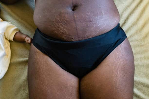 Postpartum stretch marks on the belly