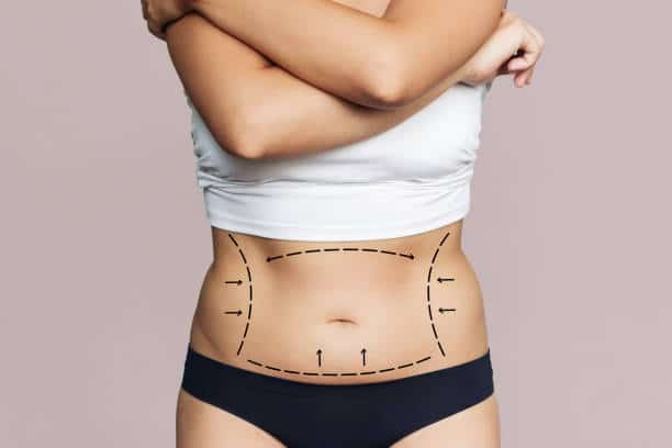 Cropped shot of a young woman's body with excess fat with marking on her belly isolated on a beige background. Overweight, flabby and sagging stomach. Liposuction, plastic surgery concept