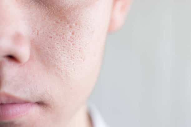 Imagen de primer plano de un hombre asiático de media cara con un problema de piel de poros anchos