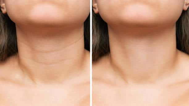 Сlose-up of young woman's neck with wrinkles before and after treatment. Result of cosmetic rejuvenating procedures. Lines, age-related changes, Venus rings. A neck lift, collagen injections, skincare