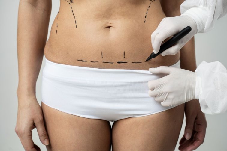 A Scarless Journey: Strategies for Optimal Healing Post-Liposuction