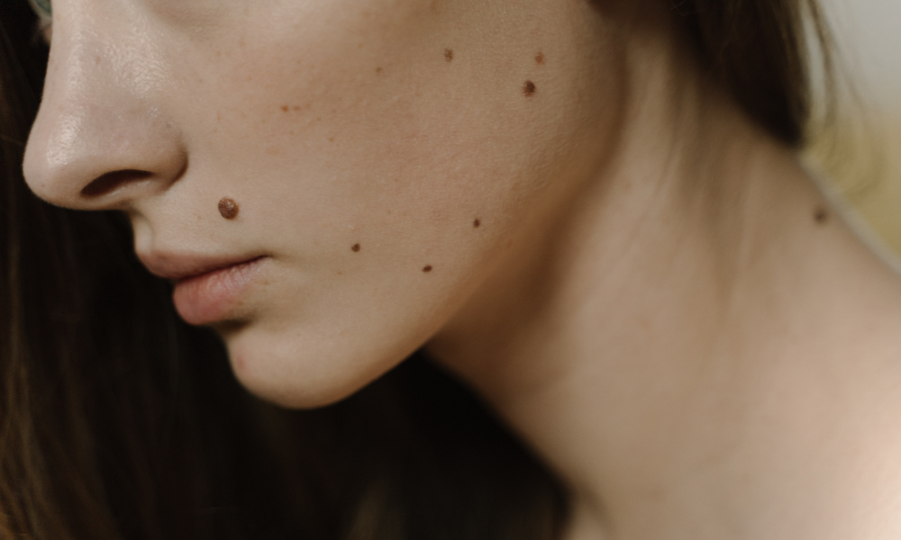 Protect Your Skin: How to Prevent Infection After Mole Removal